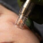 Microneedling Services at Prism West for Fine Lines & Aging Skin